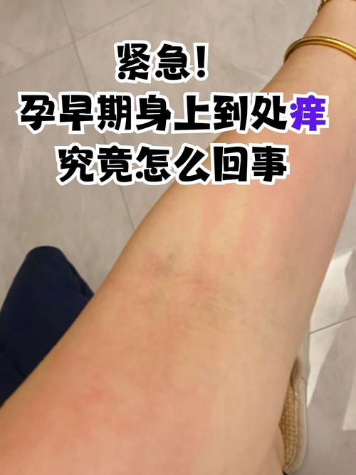 孕期身上痒是何原因？-第1张图片-中州医学会