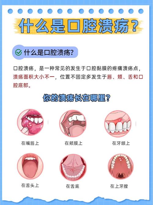 儿童口腔溃疡频发,是缺营养还是免疫力差?-第1张图片-中州医学会 儿童口腔溃疡频发,是缺营养还是免疫力差?-第1张图片-中州医学会