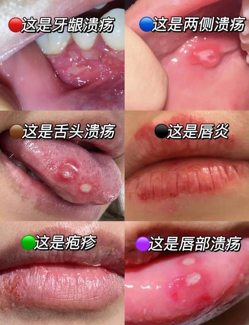 儿童口腔溃疡频发，是缺营养还是免疫力差？-第3张图片-中州医学会