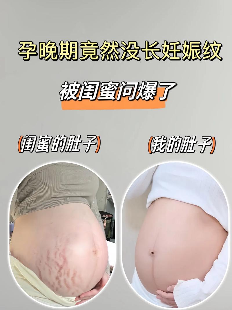 孕期没长纹，产后会突然冒出来吗？-第1张图片-中州医学会