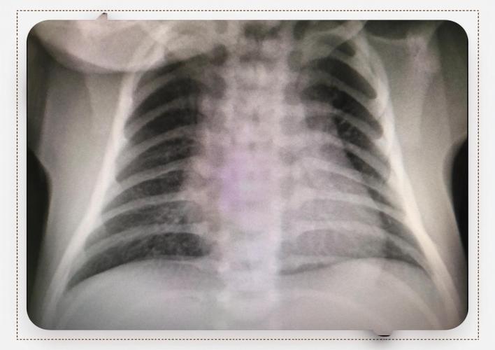 新生儿肺部阴影是何原因？-第2张图片-中州医学会