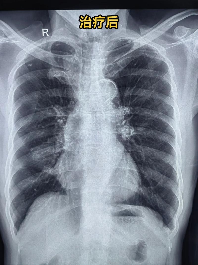 新生儿肺部阴影是何原因？-第3张图片-中州医学会