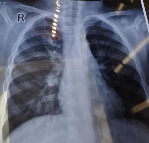 新生儿肺部阴影是何原因？-第1张图片-中州医学会