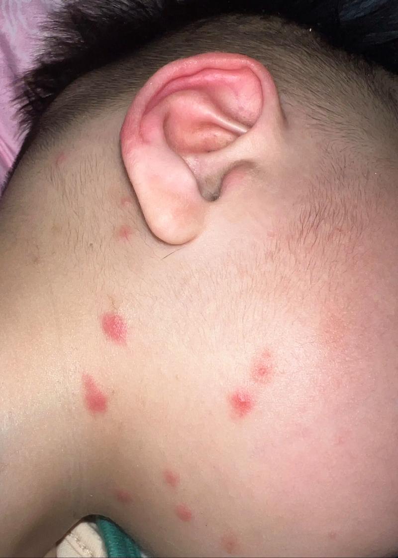 新生儿红点是啥原因？-第3张图片-中州医学会