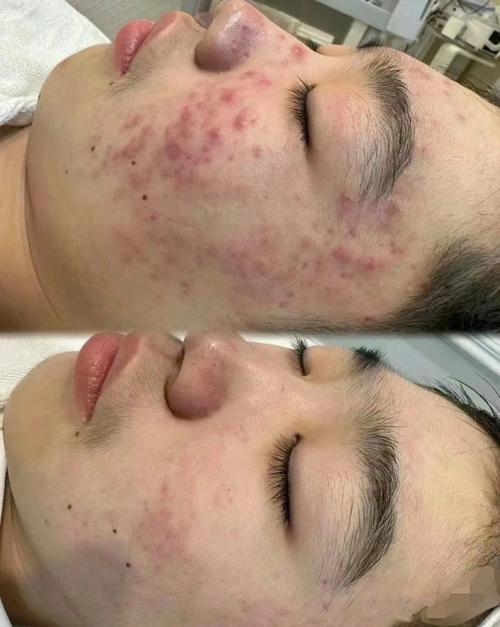 孕期长痘怎么办？-第3张图片-中州医学会