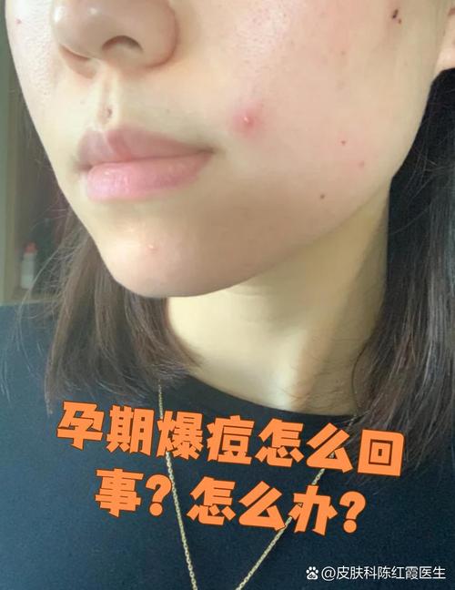 孕期长痘怎么办？-第2张图片-中州医学会
