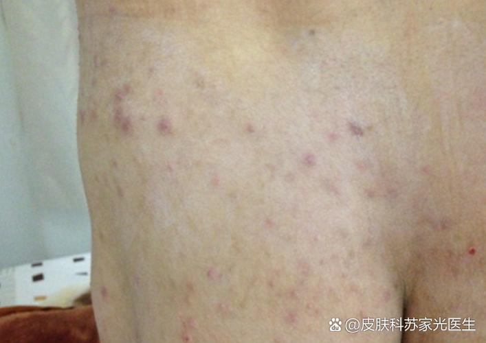 孕期屁股长痘痘是激素还是卫生问题？-第3张图片-中州医学会