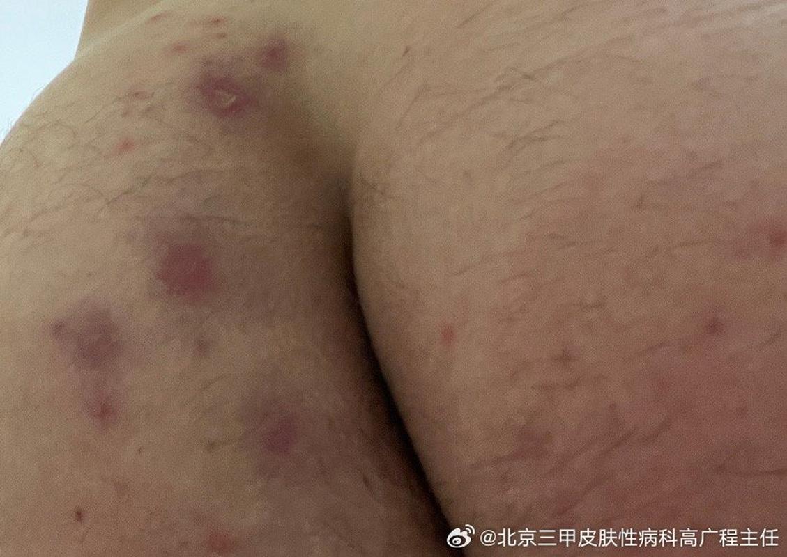 孕期屁股长痘痘是激素还是卫生问题？-第2张图片-中州医学会