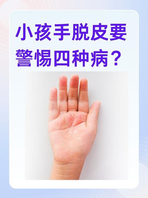 儿童手脱皮是缺乏维生素还是皮肤病?-第1张图片-中州医学会 儿童手脱皮是缺乏维生素还是皮肤病?-第1张图片-中州医学会