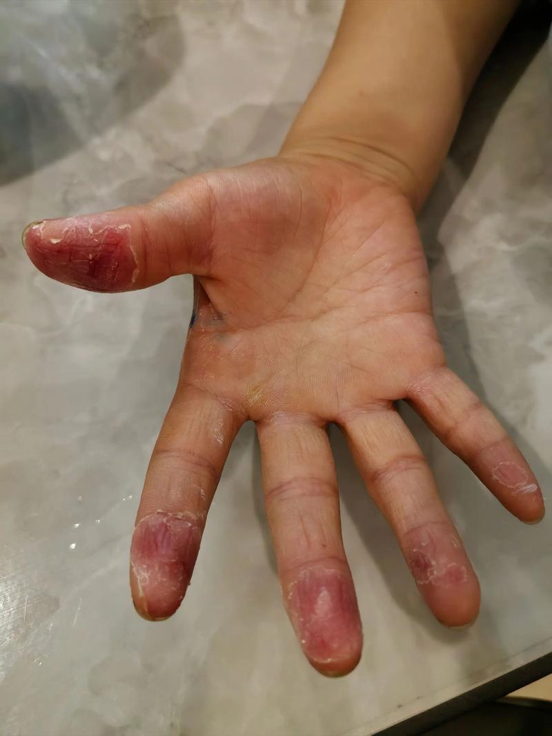 儿童手脱皮是缺乏维生素还是皮肤病?-第2张图片-中州医学会 儿童手脱皮是缺乏维生素还是皮肤病?-第2张图片-中州医学会