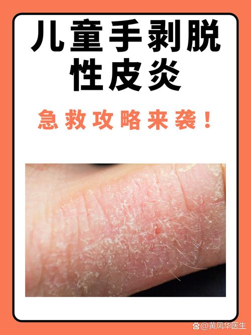 儿童手脱皮是缺乏维生素还是皮肤病?-第3张图片-中州医学会 儿童手脱皮是缺乏维生素还是皮肤病?-第3张图片-中州医学会