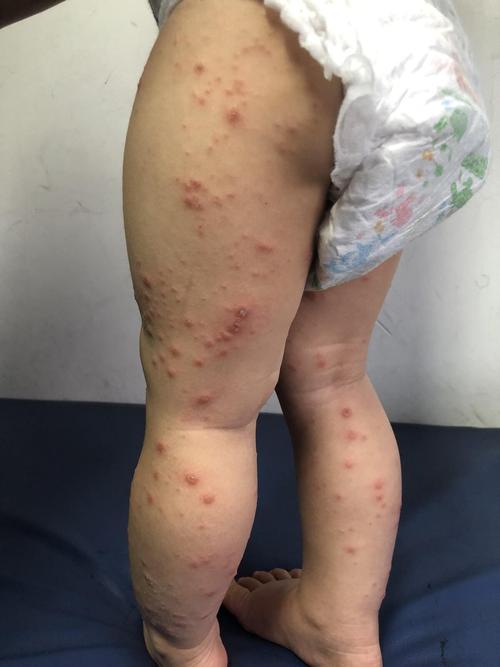 儿童出疹子症状图片怎么辨别？治疗要注意什么？-第1张图片-中州医学会