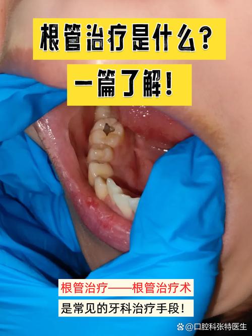 儿童牙齿根管治疗一颗要花多少钱?-第3张图片-中州医学会 儿童牙齿根管治疗一颗要花多少钱?-第3张图片-中州医学会