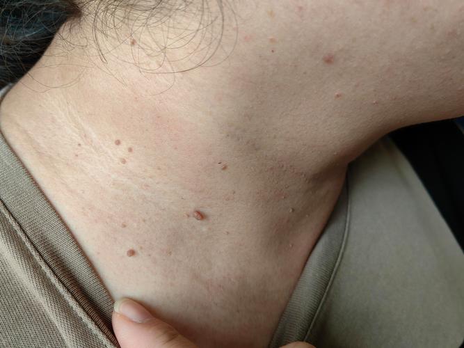 孕期皮赘产后会自行脱落吗？-第3张图片-中州医学会