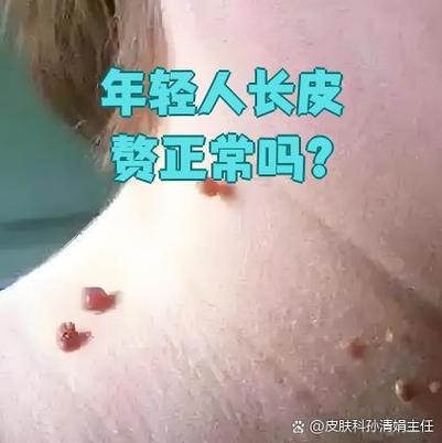 孕期皮赘产后会自行脱落吗？-第2张图片-中州医学会