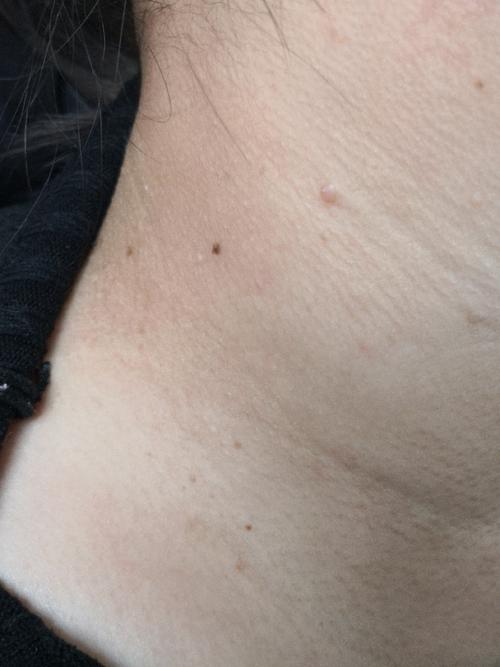 孕期皮赘产后会自行脱落吗？-第1张图片-中州医学会