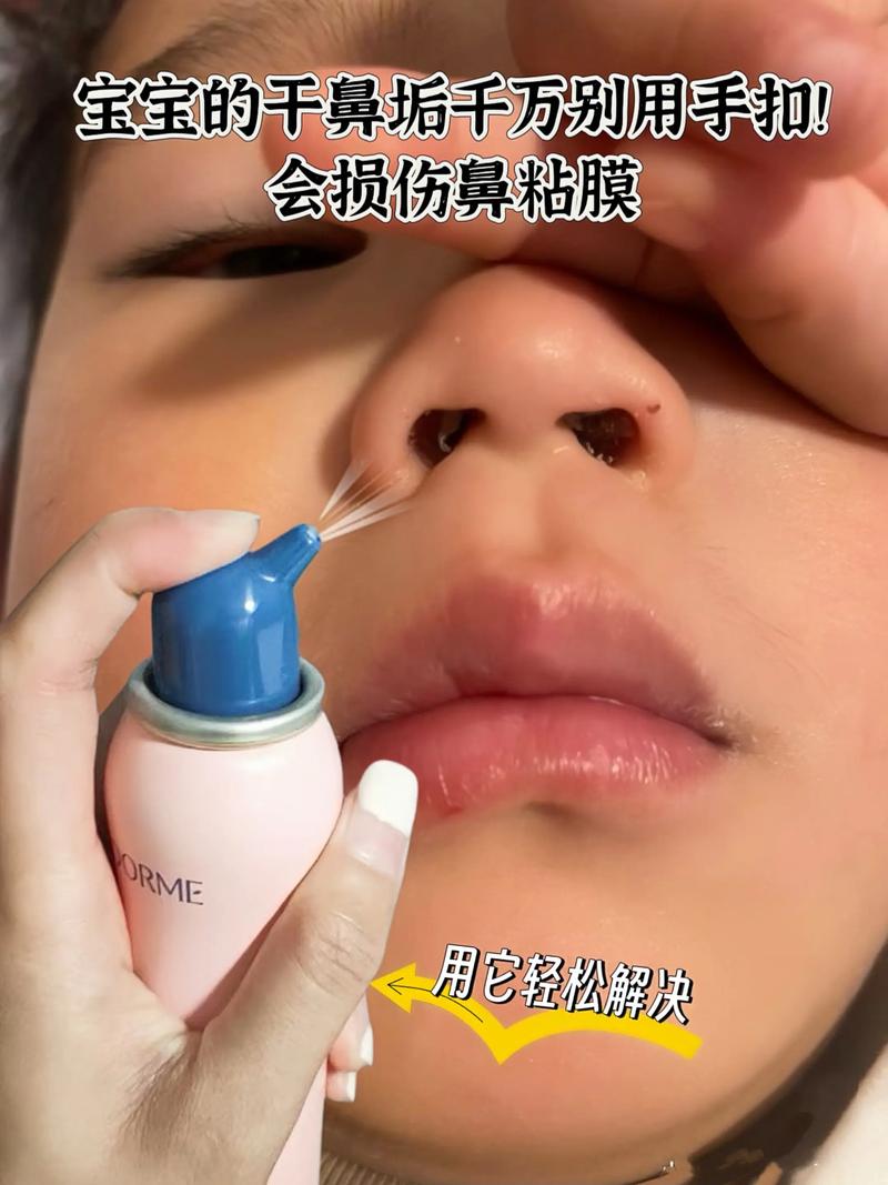 新生儿吸鼻屎了怎么办？-第1张图片-中州医学会