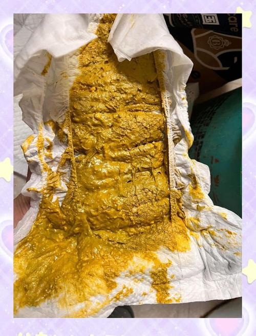 新生儿蛋花样大便是什么原因？-第3张图片-中州医学会