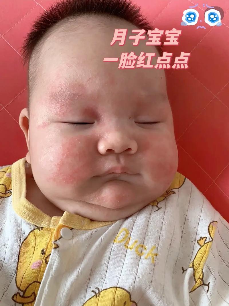 新生儿脸上小红点是啥原因?-第1张图片-中州医学会 新生儿脸上小红点是啥原因?-第1张图片-中州医学会