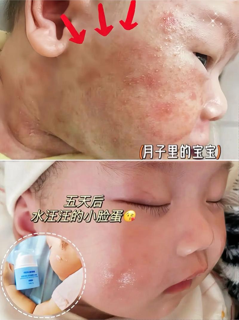 新生儿脸上小红点是啥原因?-第2张图片-中州医学会 新生儿脸上小红点是啥原因?-第2张图片-中州医学会