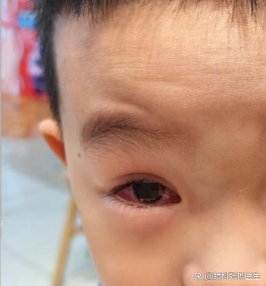 新生儿一只眼流泪有眼屎怎么办？-第2张图片-中州医学会