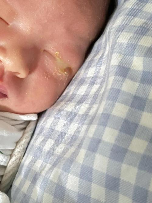 新生儿一只眼流泪有眼屎怎么办？-第1张图片-中州医学会