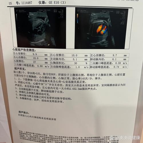 孕期心脏彩超能查出哪些胎儿问题？-第1张图片-中州医学会
