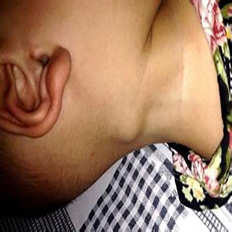 儿童颈部2-3cm淋巴结要紧吗？-第2张图片-中州医学会