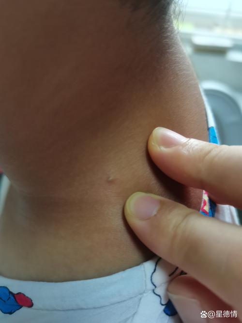 儿童颈部2-3cm淋巴结要紧吗？-第1张图片-中州医学会