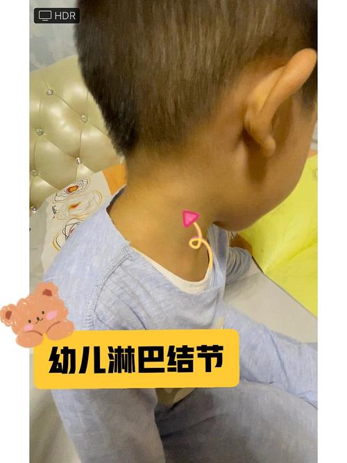 儿童颈部2-3cm淋巴结要紧吗？-第3张图片-中州医学会