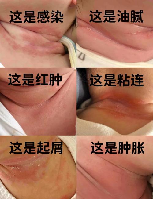 母体链球菌感染新生儿危害有多大？-第1张图片-中州医学会