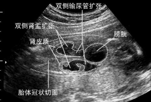 新生儿肾盂分离5mm要紧吗？-第1张图片-中州医学会