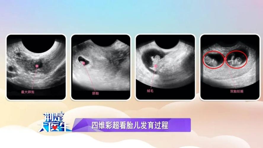 新生儿肾盂分离5mm要紧吗？-第2张图片-中州医学会