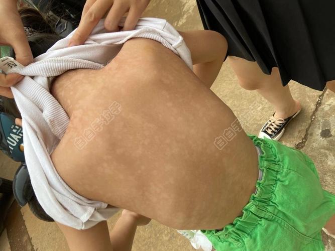 新生儿白斑是何原因？-第2张图片-中州医学会