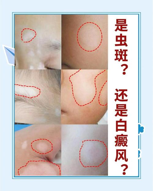 新生儿白斑是何原因？-第1张图片-中州医学会