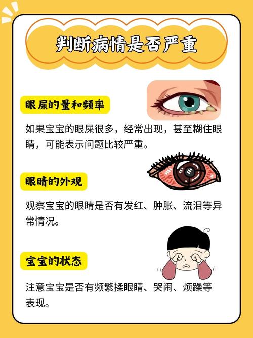 新生儿眼屎多,是上火还是生病了?-第1张图片-中州医学会 新生儿眼屎多,是上火还是生病了?-第1张图片-中州医学会