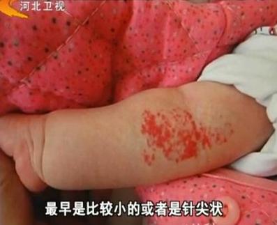 新生儿脸上有红色胎记怎么办?-第2张图片-中州医学会 新生儿脸上有红色胎记怎么办?-第2张图片-中州医学会