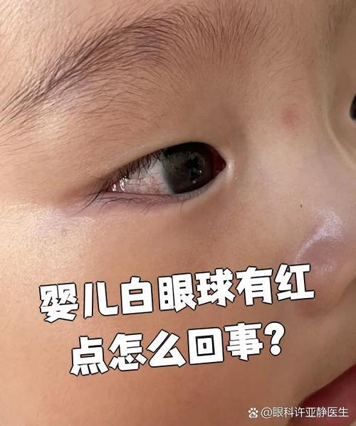 新生儿眼睛红点是何原因？-第3张图片-中州医学会