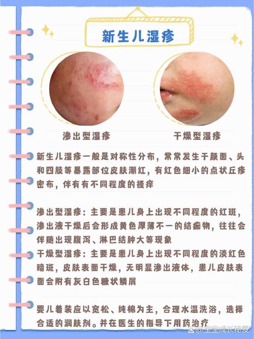 新生儿湿疹该挂皮肤科还是儿科?-第1张图片-中州医学会 新生儿湿疹该挂皮肤科还是儿科?-第1张图片-中州医学会