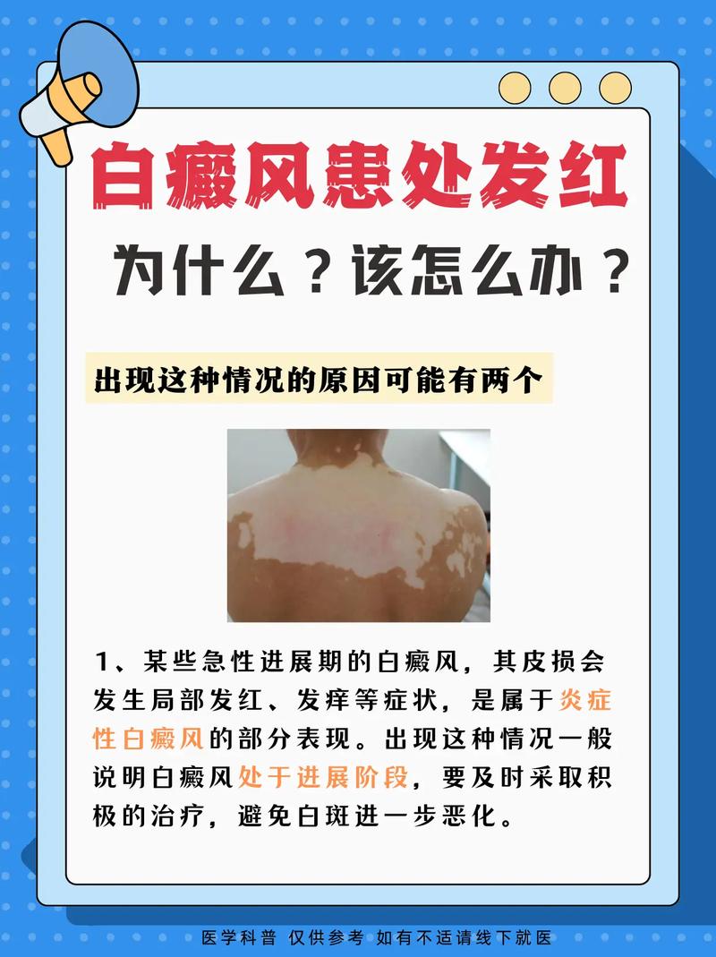 儿童白癜风诱因有哪些？-第3张图片-中州医学会