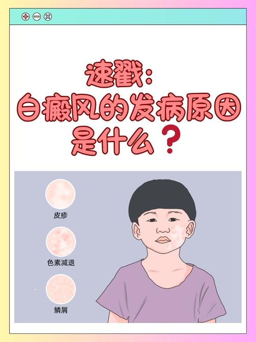 儿童白癜风诱因有哪些？-第2张图片-中州医学会
