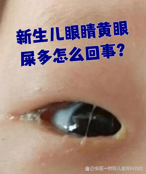 新生儿眼屎多是上火还是生病？-第2张图片-中州医学会