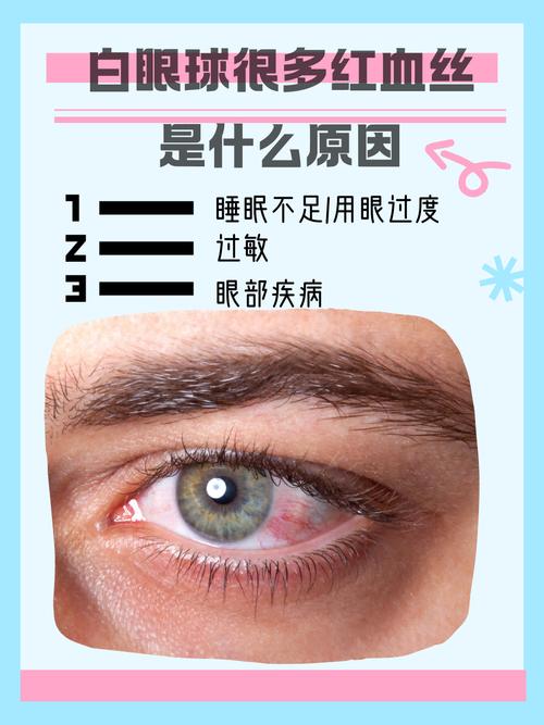新生儿眼白有血丝是何原因？-第3张图片-中州医学会