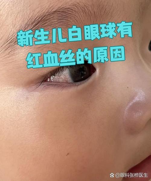 新生儿眼白有血丝是何原因？-第1张图片-中州医学会