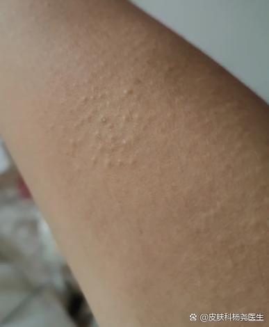 儿童皮肤像鸡皮怎么办？-第2张图片-中州医学会