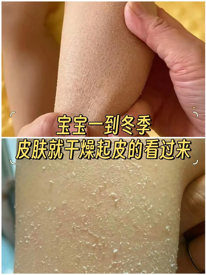 儿童皮肤像鸡皮怎么办？-第1张图片-中州医学会