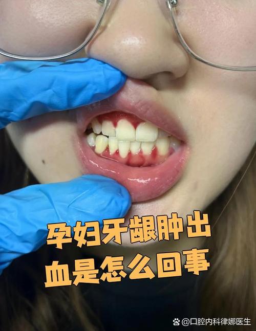 孕期牙龈出血是缺钙还是激素变化?-第2张图片-中州医学会 孕期牙龈出血是缺钙还是激素变化?-第2张图片-中州医学会