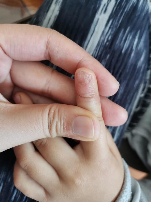 儿童手指甲坑坑洼洼是缺什么吗?-第1张图片-中州医学会 儿童手指甲坑坑洼洼是缺什么吗?-第1张图片-中州医学会