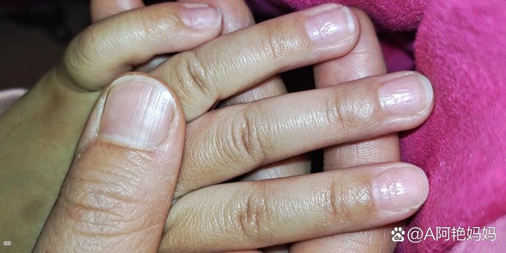 儿童手指甲坑坑洼洼是缺什么吗?-第3张图片-中州医学会 儿童手指甲坑坑洼洼是缺什么吗?-第3张图片-中州医学会