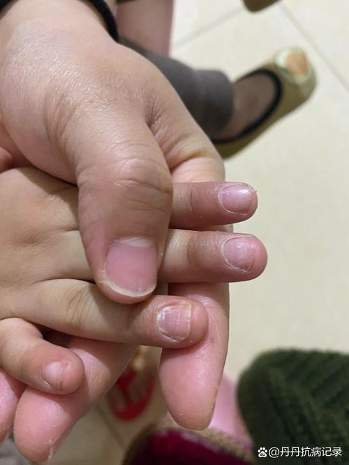 儿童手指甲坑坑洼洼是缺什么吗?-第2张图片-中州医学会 儿童手指甲坑坑洼洼是缺什么吗?-第2张图片-中州医学会
